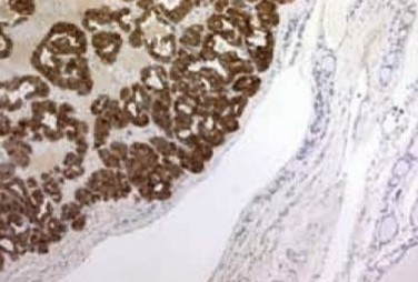 Figure 6 . Epithelial cells with an organoid and trabecular pattern with positive immunohystochemical staining for chromogranin .