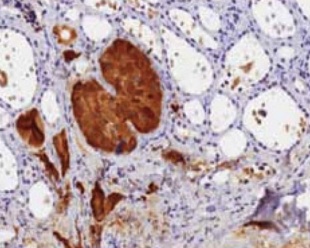 Figure 7 . Epithelial cells with an organoid and trabecular pattern with positive immunohystochemical staining for calcitonin .