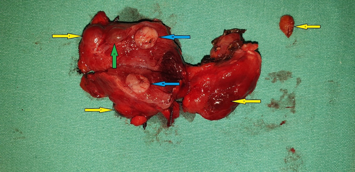 Figure 5 . Surgical  specimen a) Blue  arrows: encapsulated  medullary  microcarcinoma b) Yellow  arrows : parathyroid  glands . c) Green  arrow : Benign  thyroid  nodule . ( Courtesy  Dr . V . Penopoulos ) .