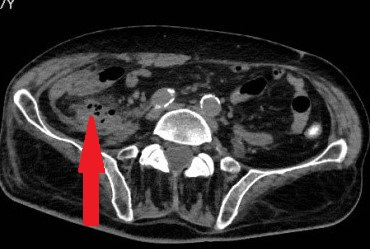 Σχήμα 6 . Επαναληπτική αξονική τομογραφία κοιλίας . Σχηματισμός αποστήματος . ( Ευγενική παραχώρηση Δρ. Β. Πενόπουλος ) .