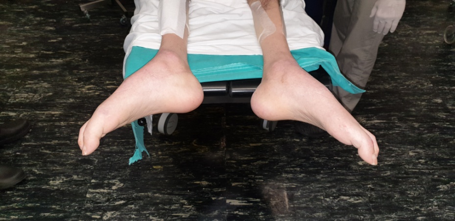 Σχήμα 2 . Σοβαρό pes planus (talipes calcaneovalgus) .(Ευγενική παραχώρηση Δρ. Β. Πενόπουλος) .