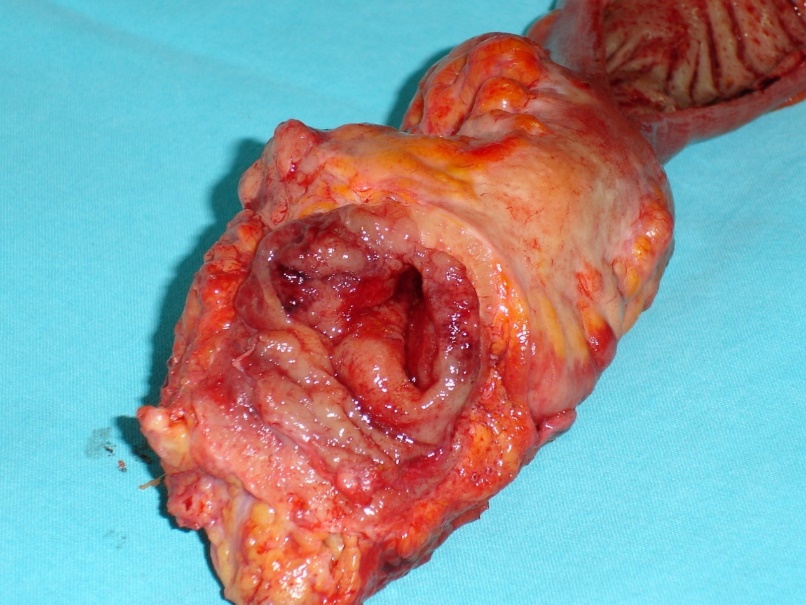 Σχήμα 3 . Δείγμα κολεκτομής (ευγενική παραχώρηση Δρ. Β. Πενόπουλος) .