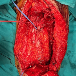 Σχήμα 3 . Χειρουργικό πεδίο μετά την εκτομή του σαρκώματος . (Ευγενική παραχώρηση Δρ. Β. Πενόπουλος) .