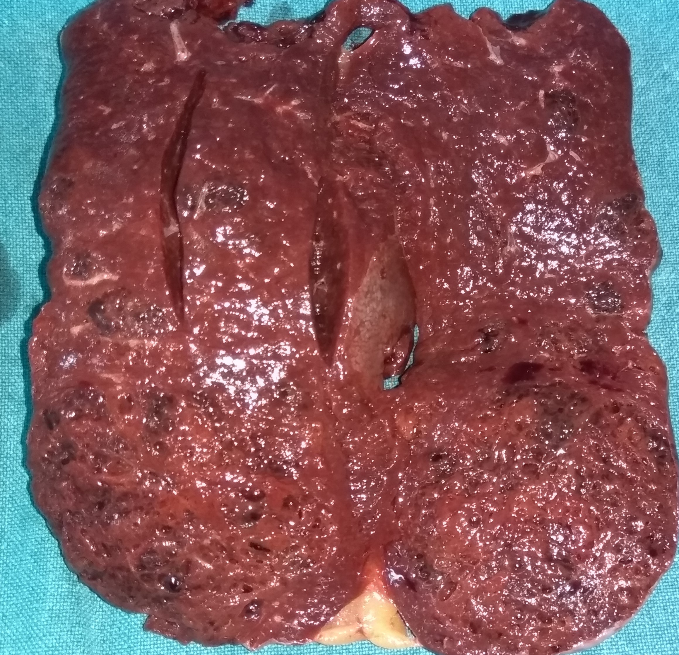 Figure 2 . The  cut  surface  of  the  spleen , showing  multiple  sponge-like  vascular  spaces . ( Courtesy  Dr . V . Penopoulos ) .