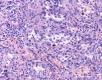 Figure 4 .Anastomosing channels lined by tall and plump cells, showing micropapillary architecture in some regions, but without nuclear atypia or mitotic activity. Deposition of hemosiderin can be seen in some cells. ( Courtesy  Dr . V . Penopoulos ) .