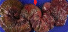 Figure 3 . A gross surgical specimen shows the necrotic changed intussusception (red  arrow).