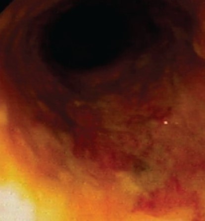 Σχήμα 2 . Μη μοναχικό έλκος του ορθού . ( Ευγενική παραχώρηση Δρ. Β. Πενόπουλος ) .