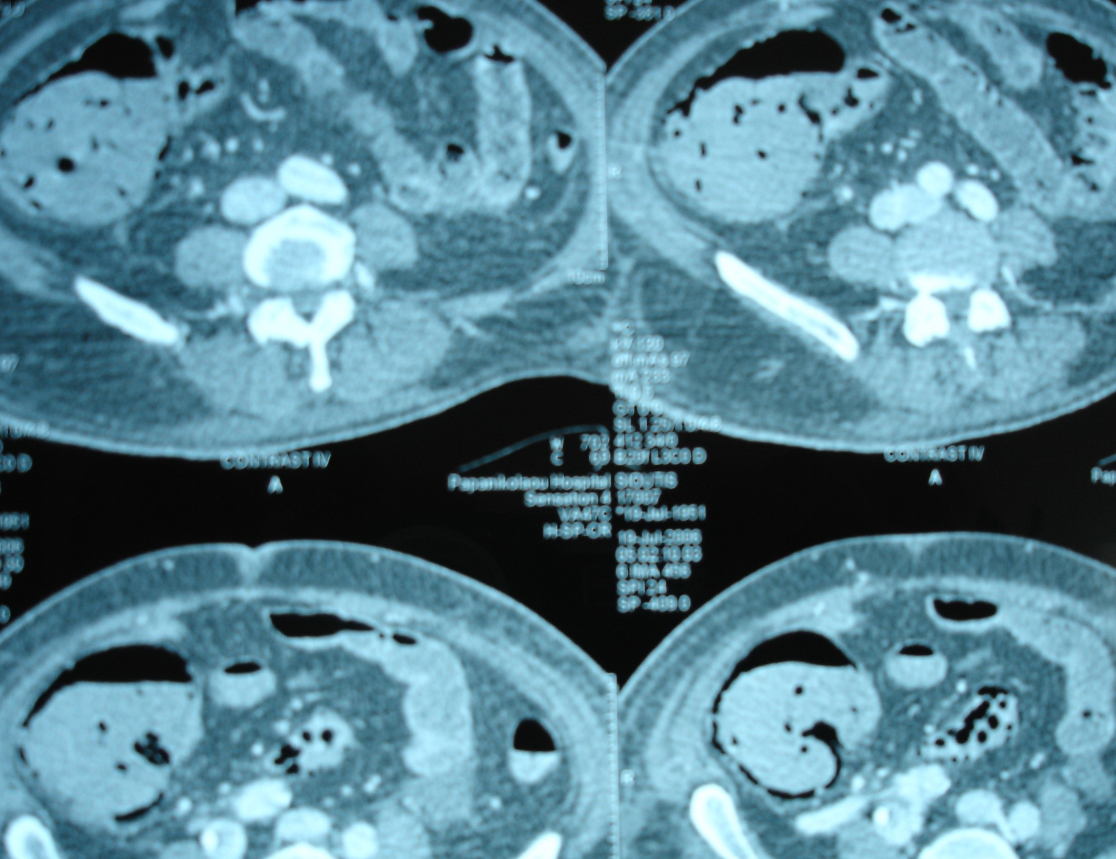 Figure 2 . Abdominal  CT  Scan  indicative  of  intestinal  ischemia . ( Courtesy   Dr . V . Penopoulos ) .
