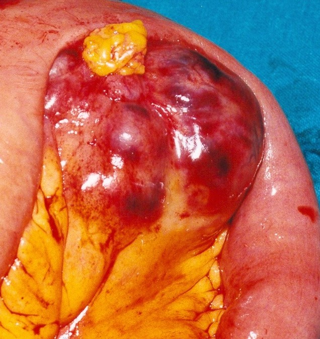 Enterectomy specimen (Courtesy Dr. V. Penopoulos)