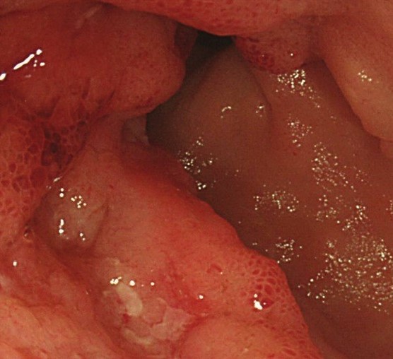 Endoscopic view of ileal maltoma (Courtesy Dr. V. Penopoulos)