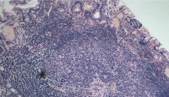 Numerous enlarged follicles with well-developed reactive germinal centres separated by a mixed infiltrate of lymphocytes, plasma cells and eosinophils (Courtesy Dr. V. Penopoulos).