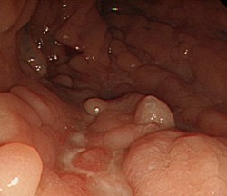 Σχήμα 2 . Ενδοσκόπηση τελικού ειλεού . ( Ευγενική παραχώρηση Δρ. Τ. Μάρις ) .