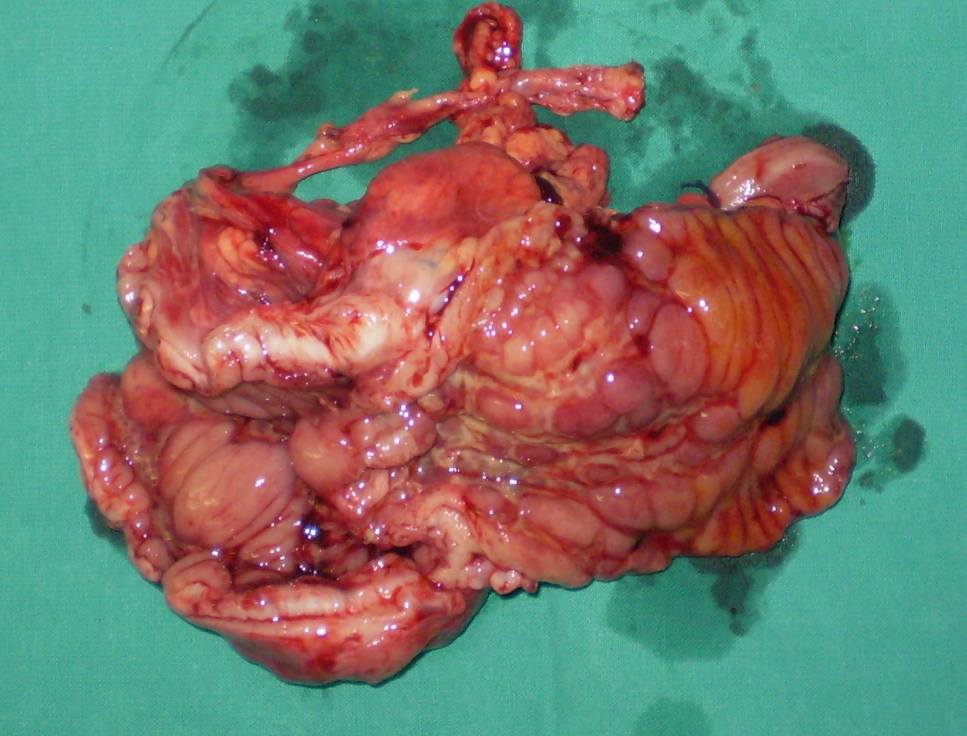 Σχήμα 3 . Μίνι δεξιά ημικολεκτομή (ευγενική παραχώρηση Δρ. Β. Πενόπουλος) .