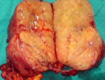 Figure 2 . Macroscopic  view  of  the  tumor – cut  surface . ( Courtesy  Dr . V. Penopoulos ) .
