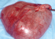 Figure 3 .  Fully  resected  mesenteric cyst. ( Courtesy  Dr . V . Penopoulos ) .