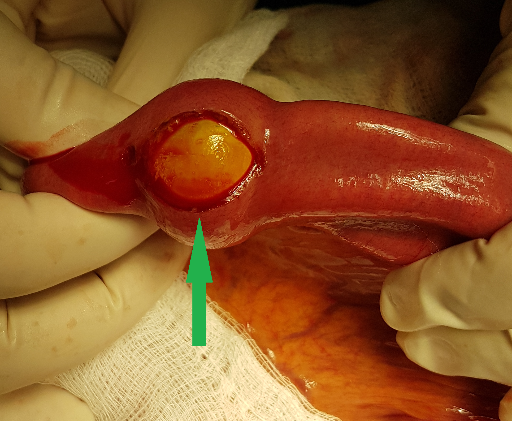 Enterotomy to free the inflated balloon (Courtesy Dr. V. Penopoulos)