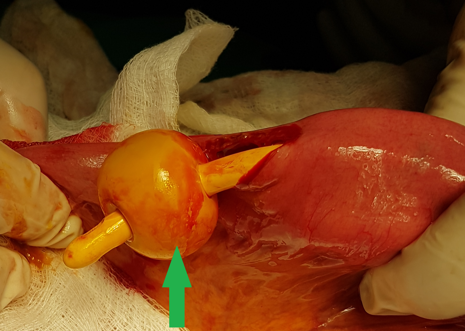 Foley catheter removed (Courtesy Dr. V. Penopoulos)