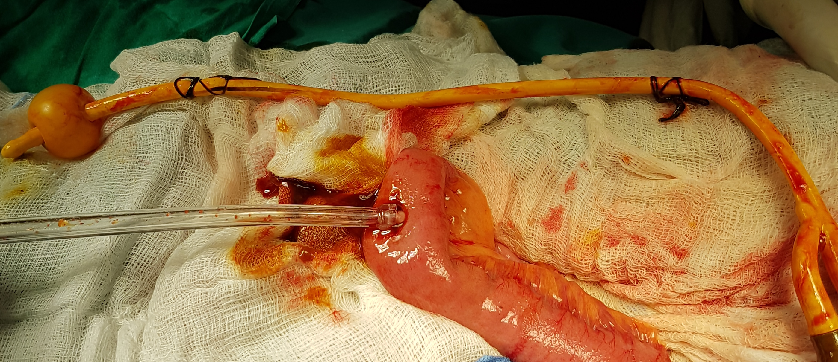 Foley catheter removed (Courtesy Dr. V. Penopoulos)