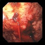 Endoscopic images Dieulafoy lesions (Courtesy Dr. V. Penopoulos)