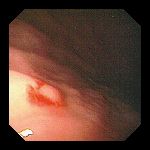 Endoscopic images Dieulafoy lesions (Courtesy Dr. V. Penopoulos)