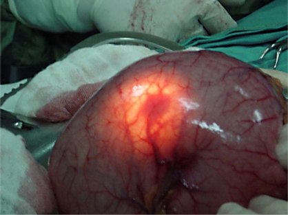 Endoscopic images Dieulafoy lesions (Courtesy Dr. V. Penopoulos)