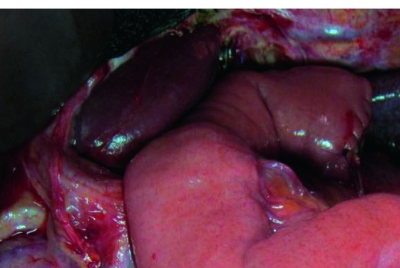 The  jejunal  interposition  loop  is  clearly  seen ( Merendino’s   technique ) (Courtesy Dr. V. Penopoulos)