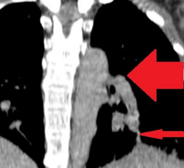 The  jejunal  interposition  loop  is  clearly  seen ( Merendino’s   technique ) (Courtesy Dr. V. Penopoulos)