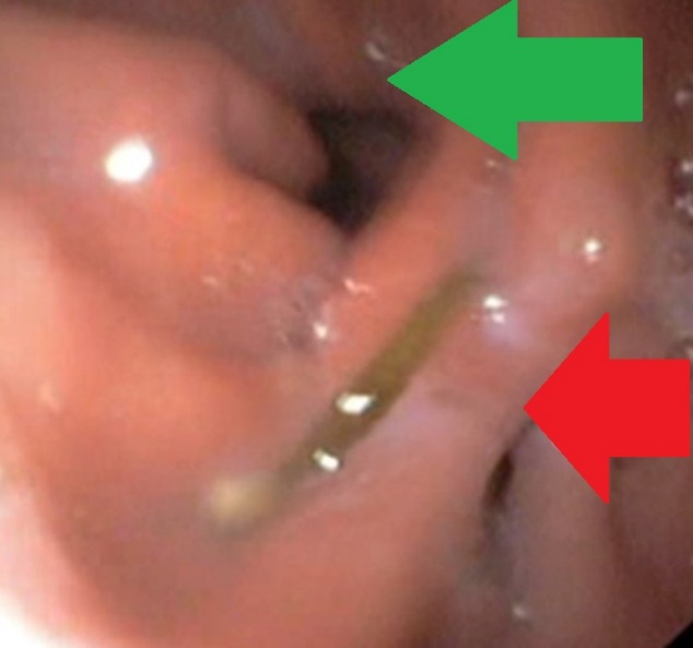The  jejunal  interposition  loop  is  clearly  seen ( Merendino’s   technique ) (Courtesy Dr. V. Penopoulos)