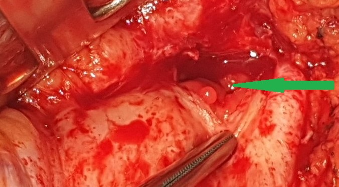 The  jejunal  interposition  loop  is  clearly  seen ( Merendino’s   technique ) (Courtesy Dr. V. Penopoulos)