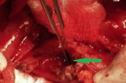 The  jejunal  interposition  loop  is  clearly  seen ( Merendino’s   technique ) (Courtesy Dr. V. Penopoulos)