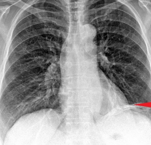 The  jejunal  interposition  loop  is  clearly  seen ( Merendino’s   technique ) (Courtesy Dr. V. Penopoulos)