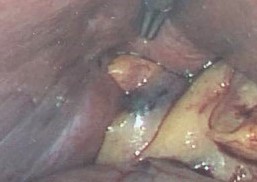 MRCP image confirms the absence of gallbladder and a normal biliary tree (Courtesy Dr. V. Penopoulos)