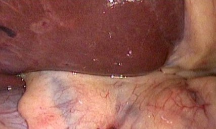 MRCP image confirms the absence of gallbladder and a normal biliary tree (Courtesy Dr. V. Penopoulos)