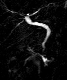 MRCP image confirms the absence of gallbladder and a normal biliary tree (Courtesy Dr. V. Penopoulos)