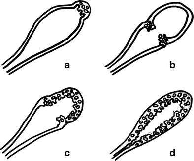 Gallbladder Diverticulosis .Gallbladder Adenomyomatosis (Courtesy Dr. V. Penopoulos)