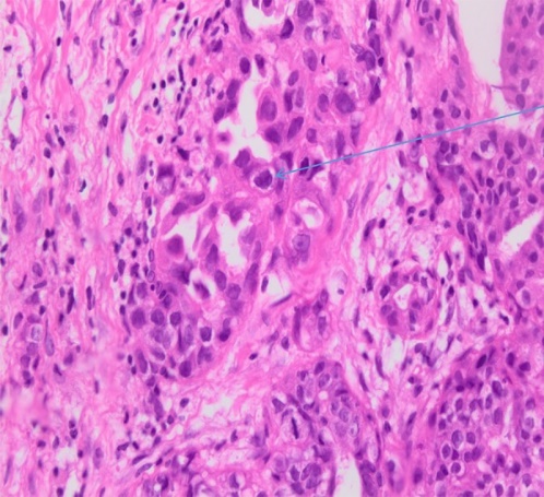 Hematoxylin and eosin staining of the omental specimen (Courtesy Dr. V. Penopoulos)