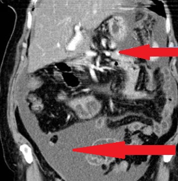 Hematoxylin and eosin staining of the omental specimen (Courtesy Dr. V. Penopoulos)