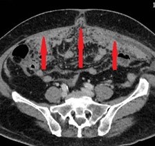 Hematoxylin and eosin staining of the omental specimen (Courtesy Dr. V. Penopoulos)