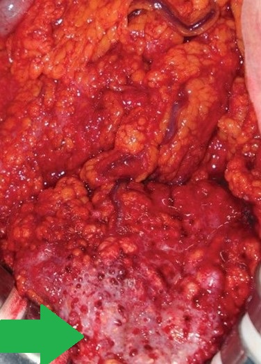 Hematoxylin and eosin staining of the omental specimen (Courtesy Dr. V. Penopoulos)