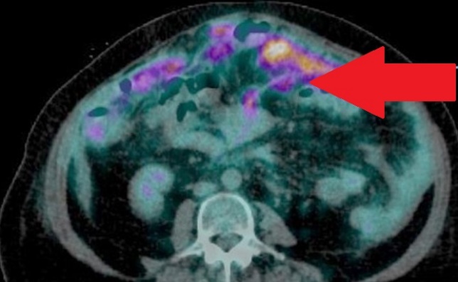 Hematoxylin and eosin staining of the omental specimen (Courtesy Dr. V. Penopoulos)