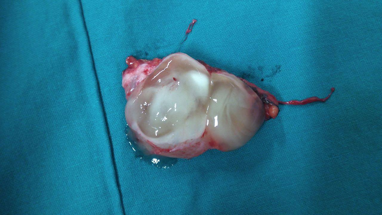 Εκταμείσα εξωαυλική περιορθική βλεννοκήλη (Ευγενική παραχώρηση Dr. V. Penopoulos)