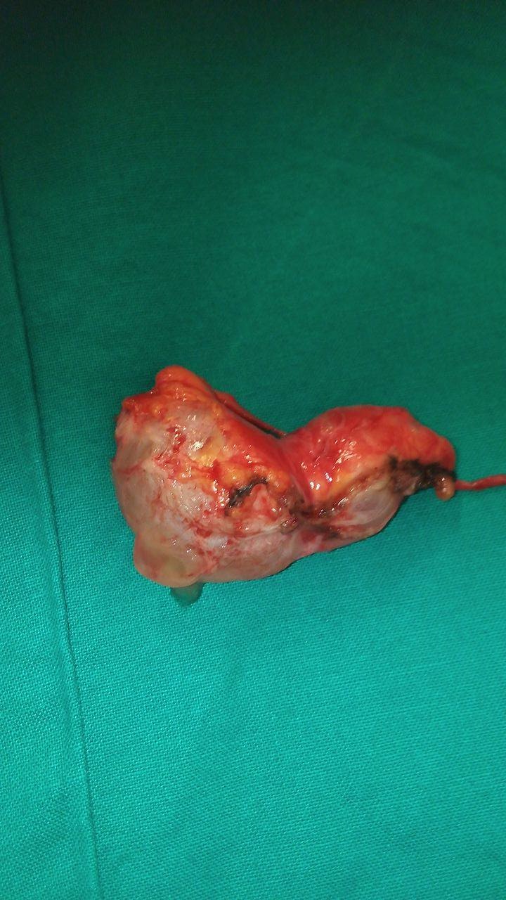 Εκταμείσα εξωαυλική περιορθική βλεννοκήλη (Ευγενική παραχώρηση Dr. V. Penopoulos)