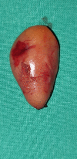 Contrast-enhanced CT demonstrates soft-tissue lesion in left carotid sheath (Courtesy Dr. V. Penopoulos)