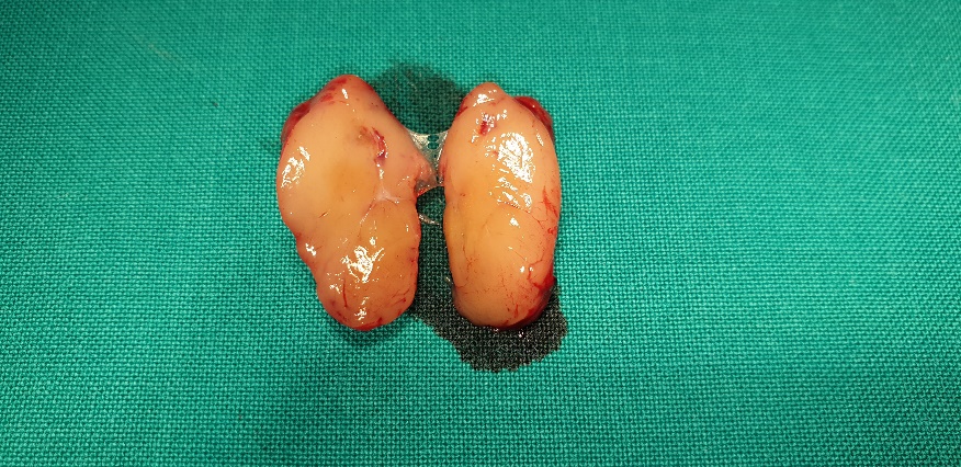 Appearance of parathyroid adenoma , after opening of the carotid sheath (Courtesy Dr. V. Penopoulos)