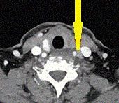 Excised Parathyroid adenoma (Courtesy Dr. V. Penopoulos)