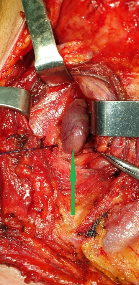 Excised  Parathyroid  adenoma (Courtesy Dr. V. Penopoulos)