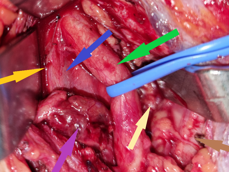 Excised  Parathyroid  adenoma (Courtesy Dr. V. Penopoulos)