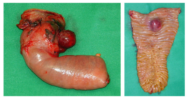 Duodenectomy sparing Vater s papilla .Poorly differentiated adenocarcinoma invading full thickness the duodenal wall and surrounding fatty tissue with clear cut margins (Courtesy Dr. V. Penopoulos)