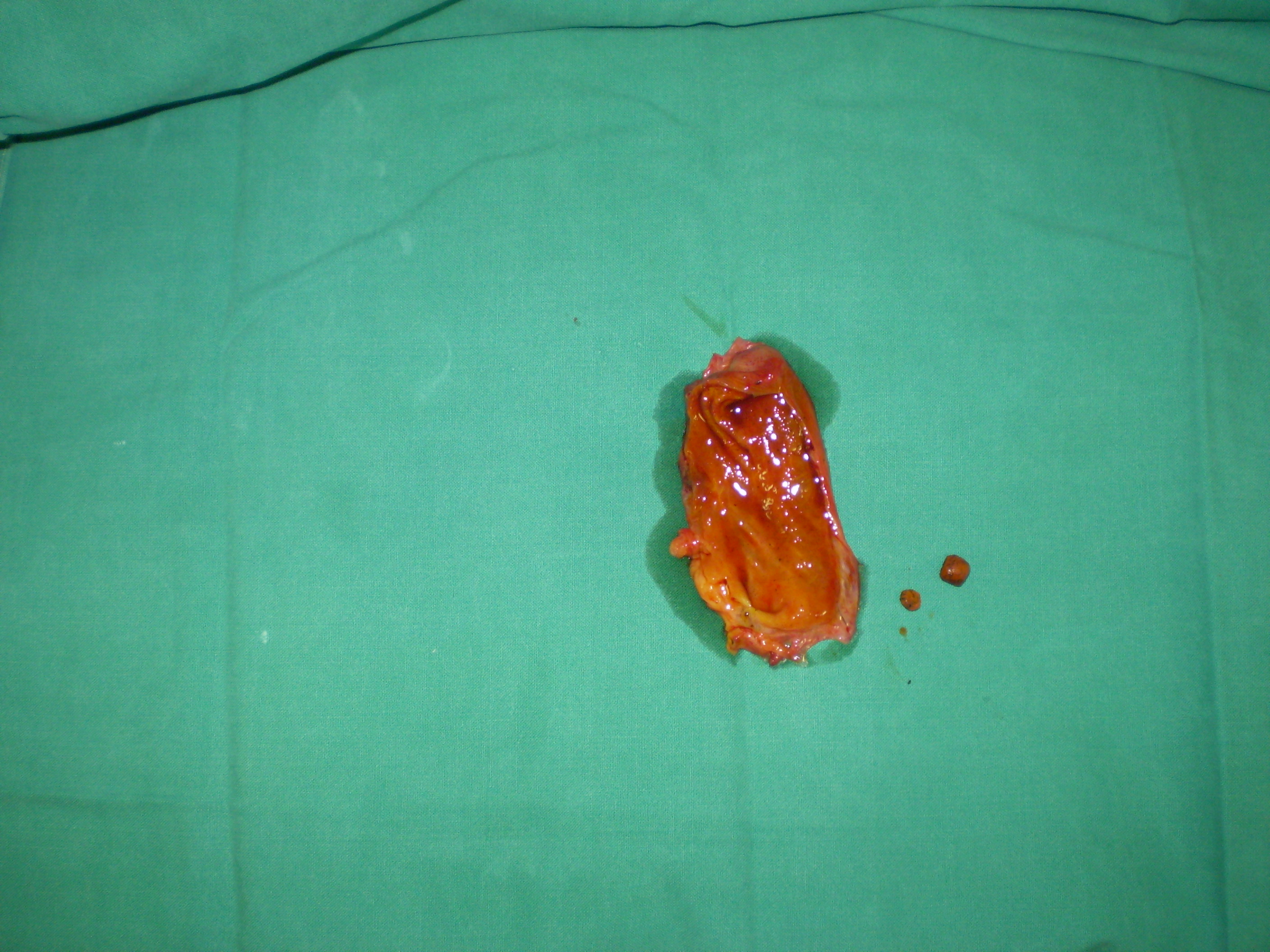 Cholecystectomy Gallstones (Courtesy Dr. V. Penopoulos)