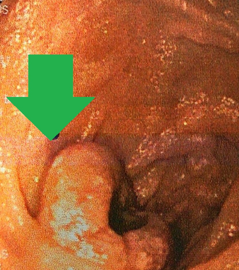 PET scan: πολλαπλές δευτεροπαθείς εναποθέσεις (Ευγενική παραχώρηση Dr. V. Penopoulos)